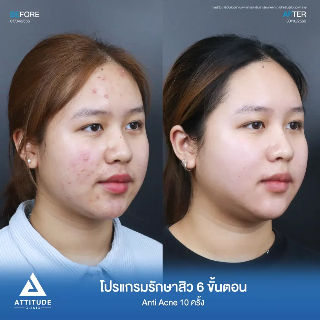 รีวิวรักษาสิวคุณปภาวี ด้วยโปรแกรม Anti Acne 6 ขั้นตอน จำนวน 10 ครั้ง รักษาสิวอักเสบ สิวอุดตัน รอยแดงทั่วใบหน้าที่ Attitude Clinic