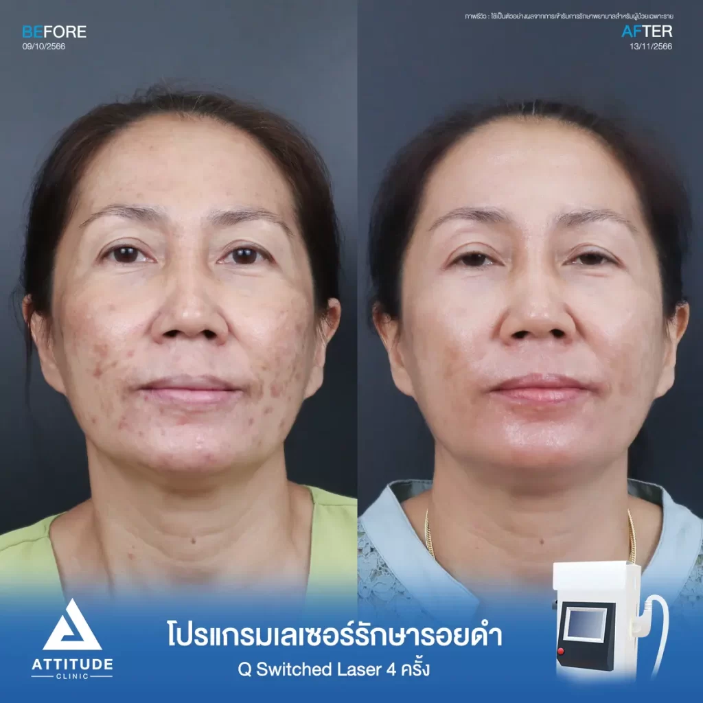 รีวิวรักษารอยดำสิวคุณสุวรี ด้วยโปรแกรม Q Switched Laser จำนวน 4 ครั้ง รักษารอยดำที่เกิดจากสิว และจุดด่างดำทั่วใบหน้า โดยเฉพาะบริเวณแก้มทั้ง 2 ข้างที่ Attitude Clinic