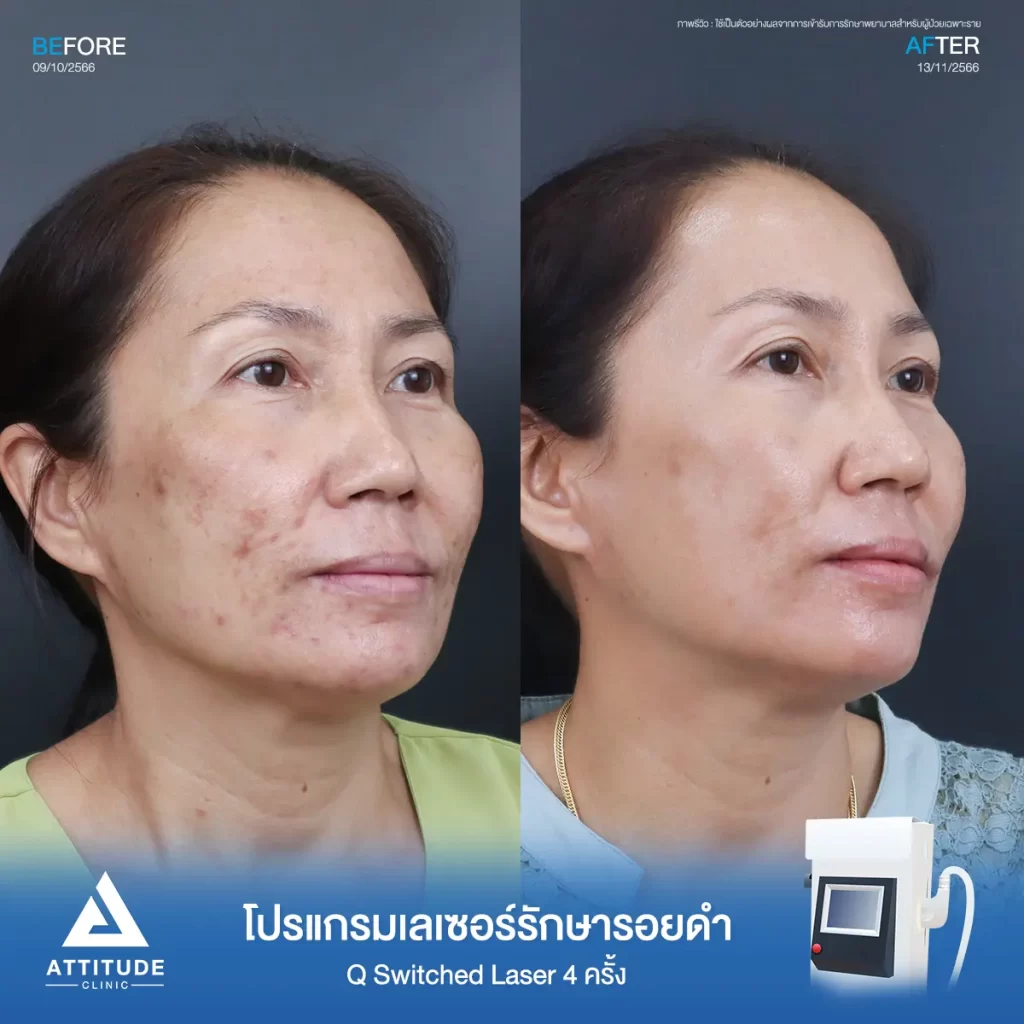 รีวิวรักษารอยดำสิวคุณสุวรี ด้วยโปรแกรม Q Switched Laser จำนวน 4 ครั้ง รักษารอยดำที่เกิดจากสิว และจุดด่างดำทั่วใบหน้า โดยเฉพาะบริเวณแก้มทั้ง 2 ข้างที่ Attitude Clinic