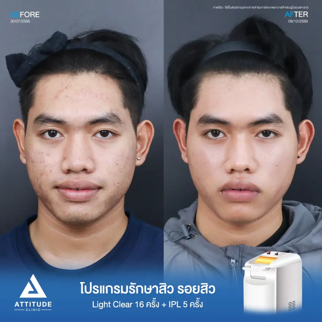 รีวิวรักษาสิวคุณนน ด้วยการฉายแสง Light Clear 7 ขั้นตอน จำนวน 16 ครั้ง และทำ IPL หน้าใส ลดรอยสิว จำนวน 5 ครั้ง รักษาสิวอักเสบ สิวอุดตัน รอยแดงจากสิวทั่วใบหน้า และช่วงต้นคอที่ Attitude Clinic