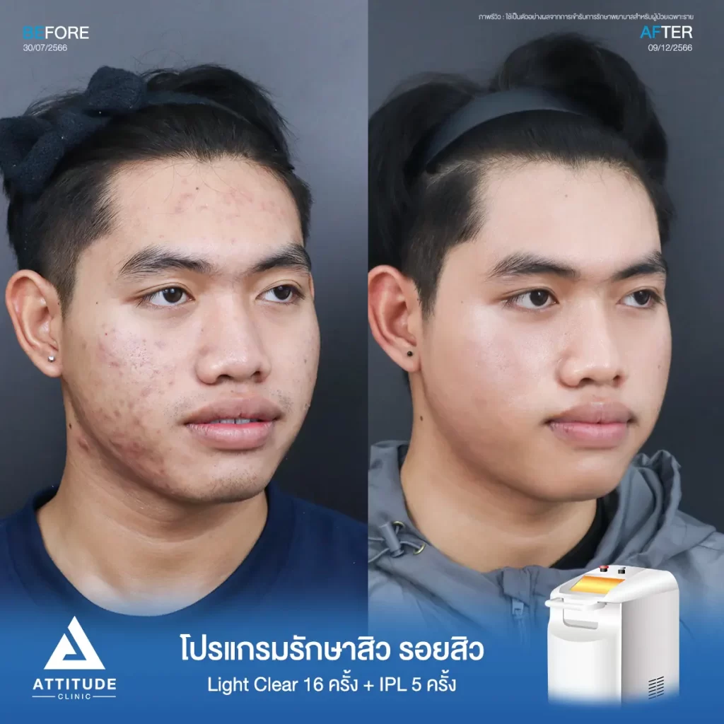 รีวิวรักษาสิวคุณนน ด้วยการฉายแสง Light Clear 7 ขั้นตอน จำนวน 16 ครั้ง และทำ IPL หน้าใส ลดรอยสิว จำนวน 5 ครั้ง รักษาสิวอักเสบ สิวอุดตัน รอยแดงจากสิวทั่วใบหน้า และช่วงต้นคอที่ Attitude Clinic