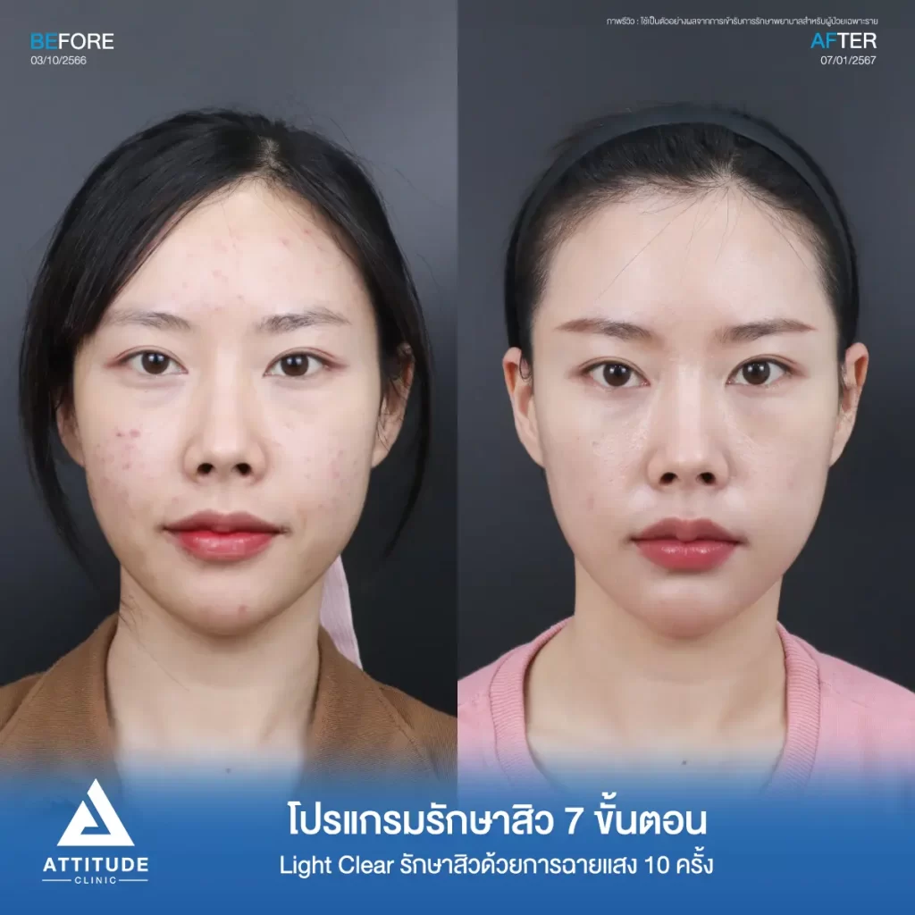 รีวิวรักษาสิวคุณฟลุ๊ค ด้วยการฉายแสง Light Clear 7 ขั้นตอน จำนวน 10 ครั้ง รักษาสิวอุดตัน สิวอักเสบ รอยแดงจากสิวทั่วใบหน้าที่ Attitude Clinic