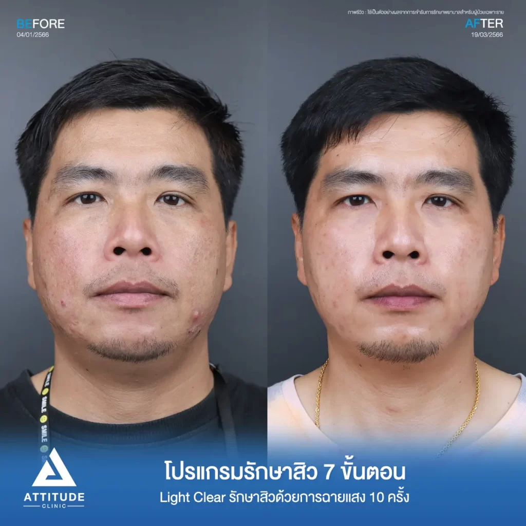 รีวิวรักษาสิวคุณรัชวุฒิ ด้วยการฉายแสง Light Clear 7 ขั้นตอน จำนวน 10 ครั้ง รักษาสิวอักเสบบริเวณกรอบหน้า รักษาสิวอุดตัน สิวผดเม็ดเล็กๆ ทั่วใบหน้าที่ Attitude Clinic