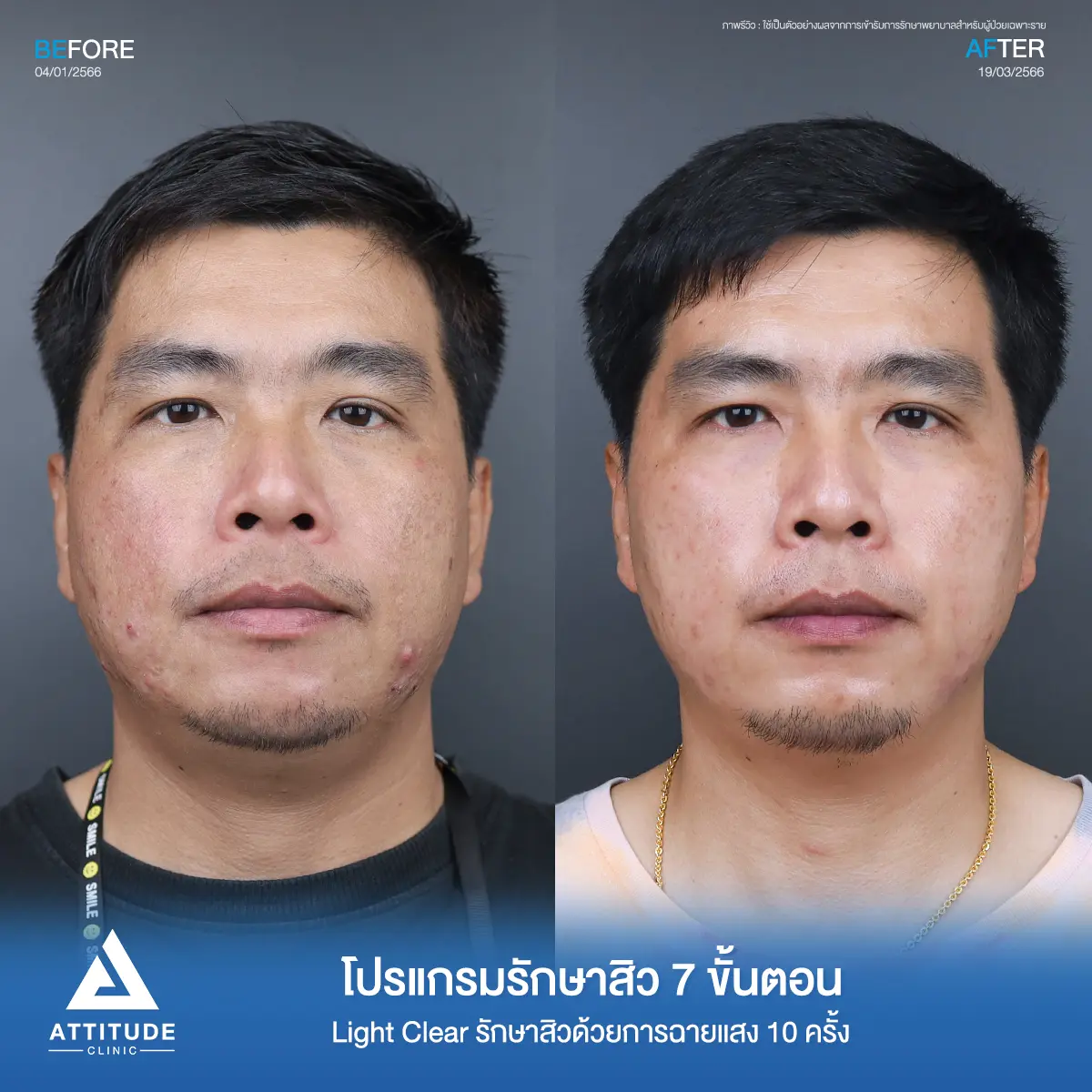 รีวิวรักษาสิวคุณรัชวุฒิ ด้วยการฉายแสง Light Clear 7 ขั้นตอน จำนวน 10 ครั้ง รักษาสิวอักเสบบริเวณกรอบหน้า รักษาสิวอุดตัน สิวผดเม็ดเล็กๆ ทั่วใบหน้าที่ Attitude Clinic