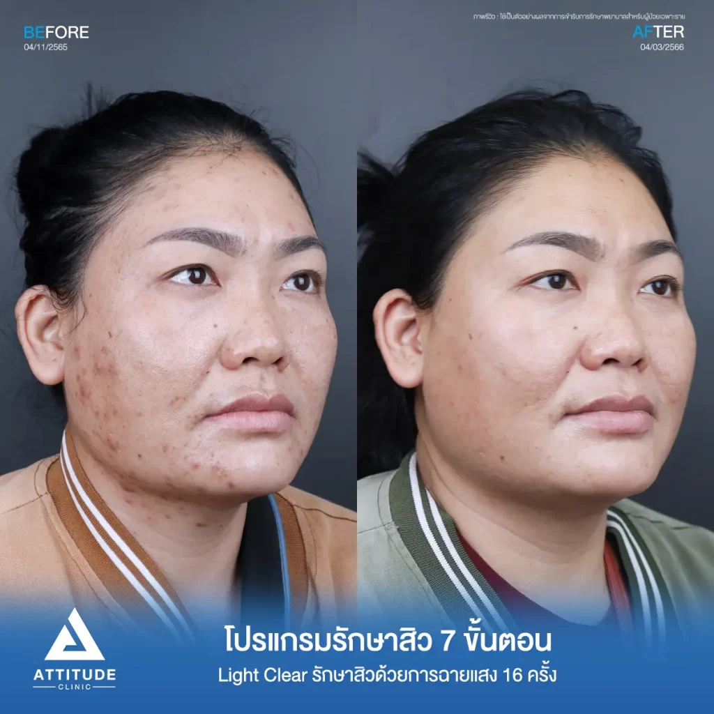 รีวิวรักษาสิวคุณอิ๋ว ด้วยการฉายแสง Light Clear 7 ขั้นตอน จำนวน 16 ครั้ง ของคุณอิ๋ว รักษาสิวอุดตัน สิวอักเสบบริเวณกรอบหน้าลงมาถึงคอที่ Attitude Clinic