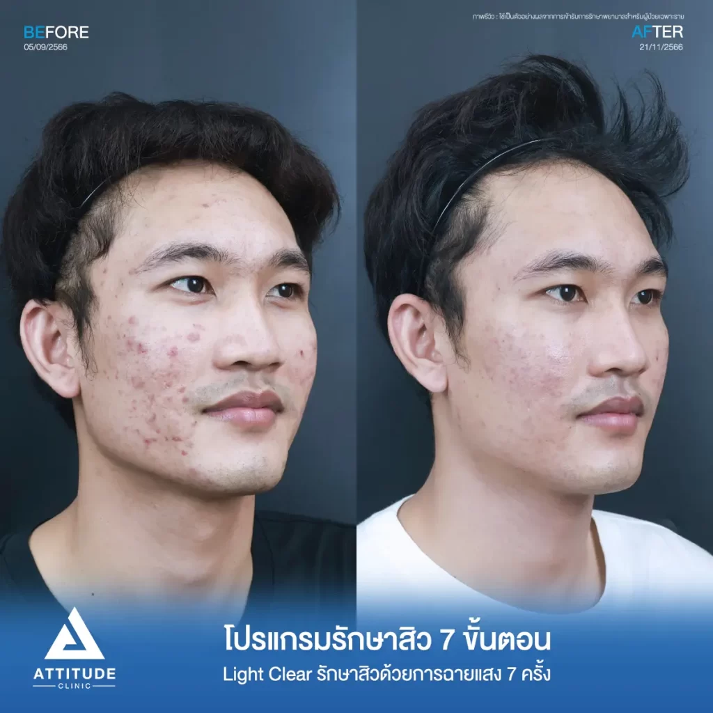 รีวิวรักษาสิวคุณเอิร์ท ด้วยการฉายแสง Light Clear 7 ขั้นตอน จำนวน 7 ครั้ง รักษาสิวอักเสบ สิวอุดตัน รอยแดงทั่วใบหน้า โดยเฉพาะบริเวณแก้ม 2 ข้างที่ Attitude Clinic