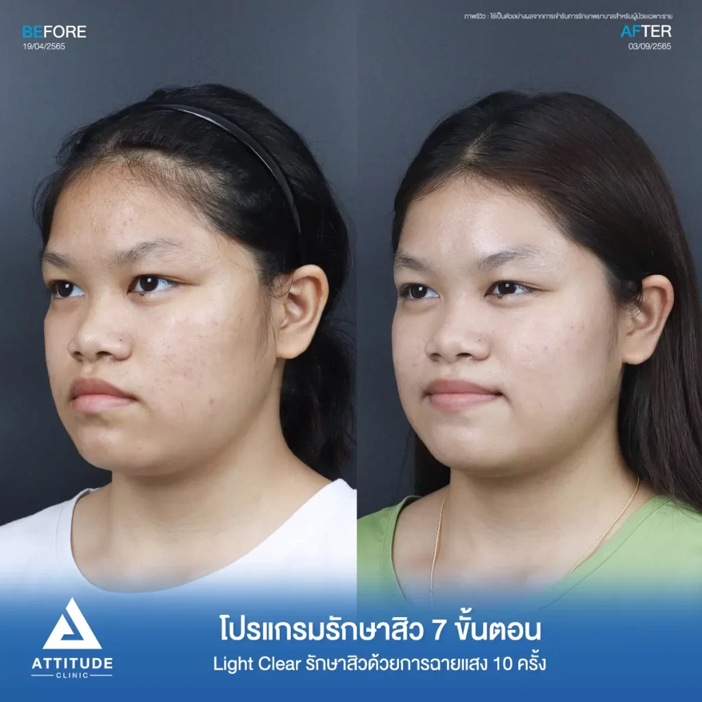 รีวิวรักษาสิวคุณเอย ด้วยการฉายแสง Light Clear 7 ขั้นตอน จำนวน 10 ครั้ง รักษาสิวผดเม็ดเล็กๆ สิวอุดตันใต้ผิวที่สังเกตเห็นได้ยากทั่วใบหน้า ที่ Attitude Clinic