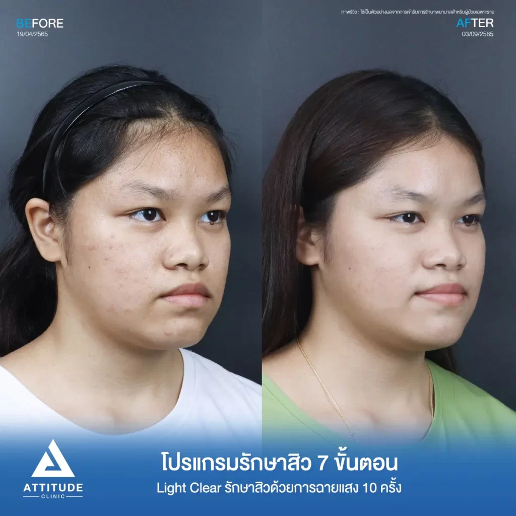 รีวิวรักษาสิวคุณเอย ด้วยการฉายแสง Light Clear 7 ขั้นตอน จำนวน 10 ครั้ง รักษาสิวผดเม็ดเล็กๆ สิวอุดตันใต้ผิวที่สังเกตเห็นได้ยากทั่วใบหน้า ที่ Attitude Clinic