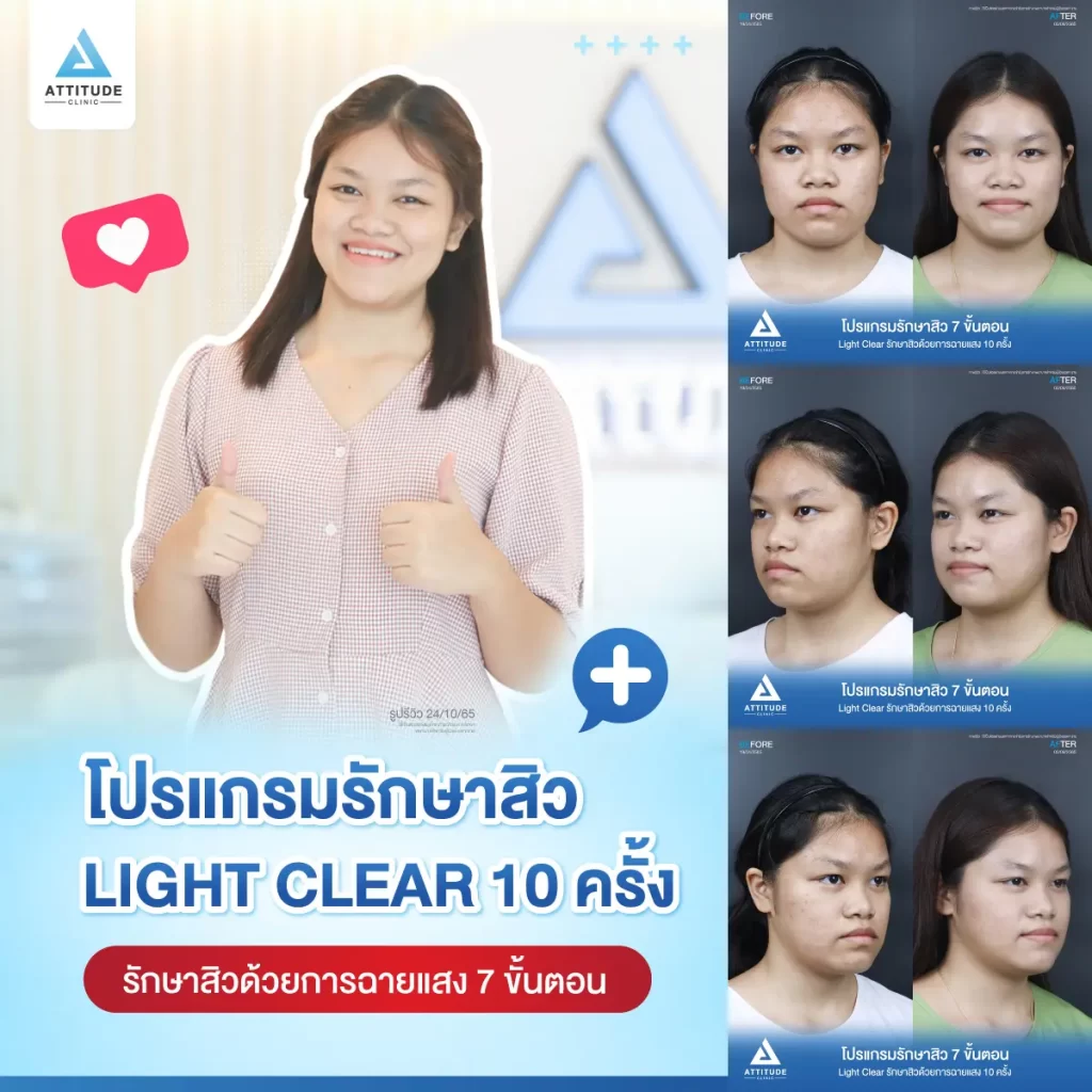 รีวิวรักษาสิวคุณเอย ด้วยการฉายแสง Light Clear 7 ขั้นตอน จำนวน 10 ครั้ง รักษาสิวผดเม็ดเล็กๆ สิวอุดตันใต้ผิวที่สังเกตเห็นได้ยากทั่วใบหน้า ที่ Attitude Clinic