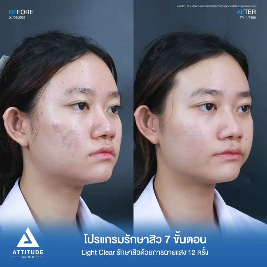 รีวิวรักษาสิวคุณเอมมี่ ด้วยการฉายแสง Light Clear 7 ขั้นตอน จำนวน 12 ครั้ง รักษาสิวอุดตัน สิวผดเม็ดเล็กๆ โดยเฉพาะบริเวณ 2 ข้างแก้มที่ Attitude Clinic