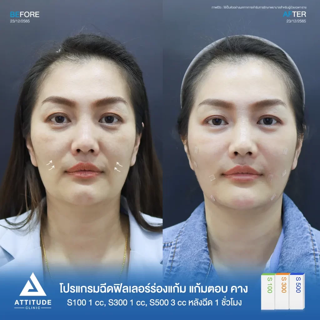 รีวิวโปรแกรมฉีดฟิลเลอร์ร่องแก้ม แก้มตอบ คางรุ่นคุณหลิว S100 S300 S500 จำนวน 5 cc หลังฉีด 1 ชั่วโมง ของคุณหลิว เติมเต็มร่องแก้ม แก้มตอบให้ใบหน้าอิ่มฟู เรียบเนียน ดูสุขภาพดี ปรับรูปคางให้เรียวสวย ได้สัดส่วนที่ Attitude Clinic