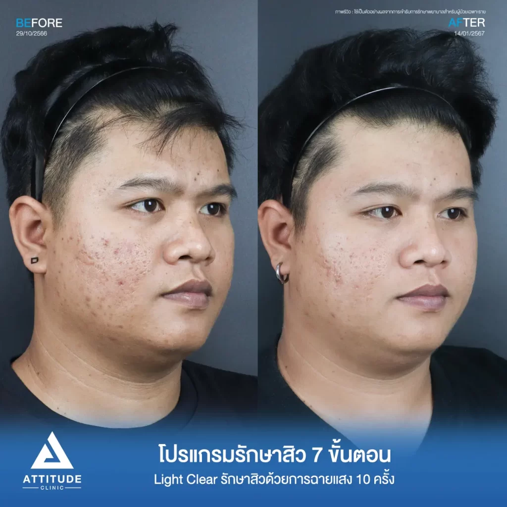 รีวิวรักษาสิวคุณแบงค์ ด้วยการฉายแสง Light Clear 7 ขั้นตอน จำนวน 10 ครั้ง รักษาสิวอุดตัน สิวผดเม็ดเล็กๆทั่วใบหน้าที่ Attitude Clinic