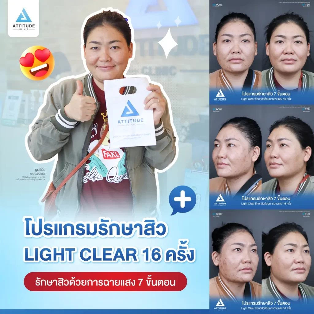 รีวิวรักษาสิวคุณอิ๋ว ด้วยการฉายแสง Light Clear 7 ขั้นตอน จำนวน 16 ครั้ง ของคุณอิ๋ว รักษาสิวอุดตัน สิวอักเสบบริเวณกรอบหน้าลงมาถึงคอที่ Attitude Clinic