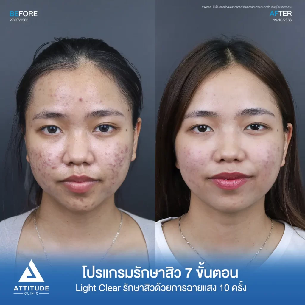 รีวิวรักษาสิวคุณระพีพร ด้วยการฉายแสง Light Clear 7 ขั้นตอน จำนวน 10 ครั้ง รักษาสิวอักเสบ สิวอุดตัน รอยแดงสิวทั่วใบหน้า กรอบหน้า และไรผมที่ Attitude Clinic