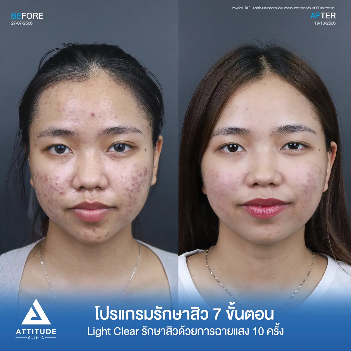 รีวิวรักษาสิวคุณระพีพร ด้วยการฉายแสง Light Clear 7 ขั้นตอน จำนวน 10 ครั้ง รักษาสิวอักเสบ สิวอุดตัน รอยแดงสิวทั่วใบหน้า กรอบหน้า และไรผมที่ Attitude Clinic
