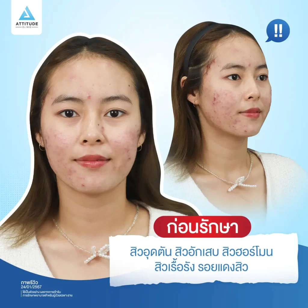 2 โปรแกรมเคลียร์หน้าใส รักษาสิว+เลเซอร์ Step จึ้งรักษาสิว และรอยสิวแบบอยู่หมัด