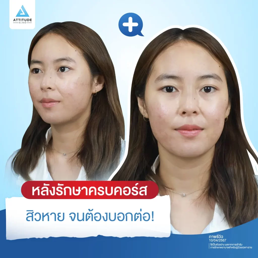 2 โปรแกรมเคลียร์หน้าใส รักษาสิว+เลเซอร์ Step จึ้งรักษาสิว และรอยสิวแบบอยู่หมัด