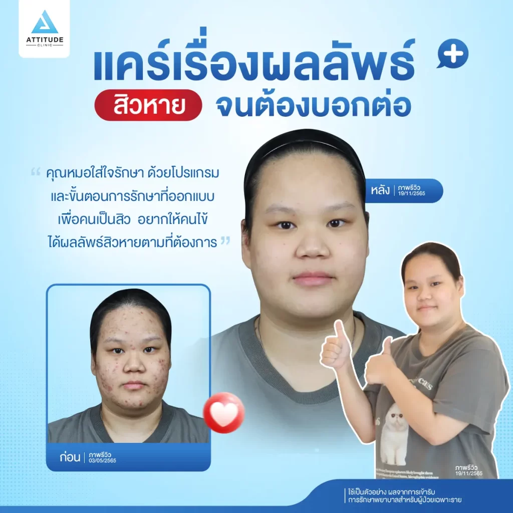 เพราะเราแคร์เรื่องรักษาสิว คุณหมอประเมิน สั่งจ่ายยาตามปัญหาสิวของคนไข้เองทุกเคสที่ Attitude Clinic
