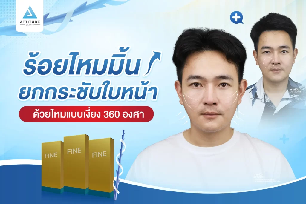 โปรแกรมร้อยไหมมิ้นท์ รุ่น Fine กับหมอต้อม ดึงยกกระชับใบหน้า ด้วยไหมแบบเงี่ยง 360 องศา ปรับรูปหน้า พลังยกรอบทิศทาง สิทธิพิเศษโอนจอง 500 บาท รับส่วนลดเพิ่ม 500 บาท รองรับการผ่อนชำระนาน 3 เดือน
