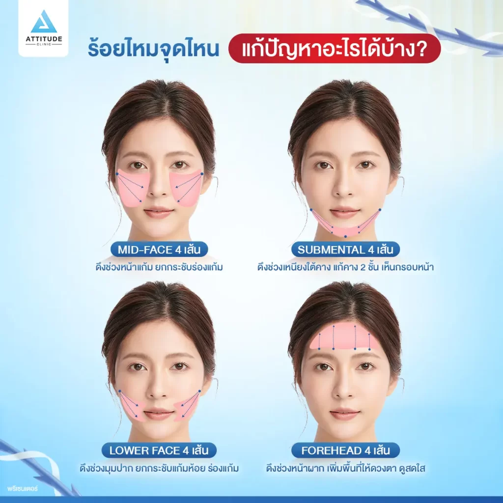 โปรแกรมร้อยไหมมิ้นท์ รุ่น Fine กับหมอต้อม ดึงยกกระชับใบหน้า ด้วยไหมแบบเงี่ยง 360 องศา ปรับรูปหน้า พลังยกรอบทิศทาง สิทธิพิเศษโอนจอง 500 บาท รับส่วนลดเพิ่ม 500 บาท รองรับการผ่อนชำระนาน 3 เดือน