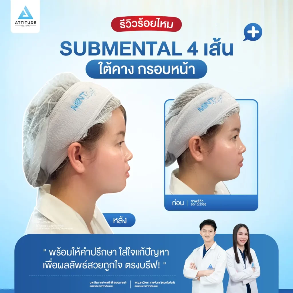 โปรแกรมร้อยไหมมิ้นท์ รุ่น Fine กับหมอต้อม ดึงยกกระชับใบหน้า ด้วยไหมแบบเงี่ยง 360 องศา ปรับรูปหน้า พลังยกรอบทิศทาง สิทธิพิเศษโอนจอง 500 บาท รับส่วนลดเพิ่ม 500 บาท รองรับการผ่อนชำระนาน 3 เดือน