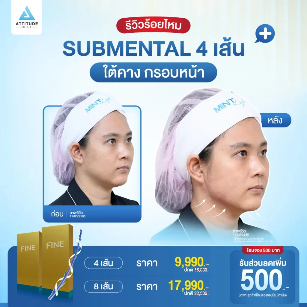 โปรแกรมร้อยไหมมิ้นท์ รุ่น Fine กับหมอต้อม ดึงยกกระชับใบหน้า ด้วยไหมแบบเงี่ยง 360 องศา ปรับรูปหน้า พลังยกรอบทิศทาง สิทธิพิเศษโอนจอง 500 บาท รับส่วนลดเพิ่ม 500 บาท รองรับการผ่อนชำระนาน 3 เดือน