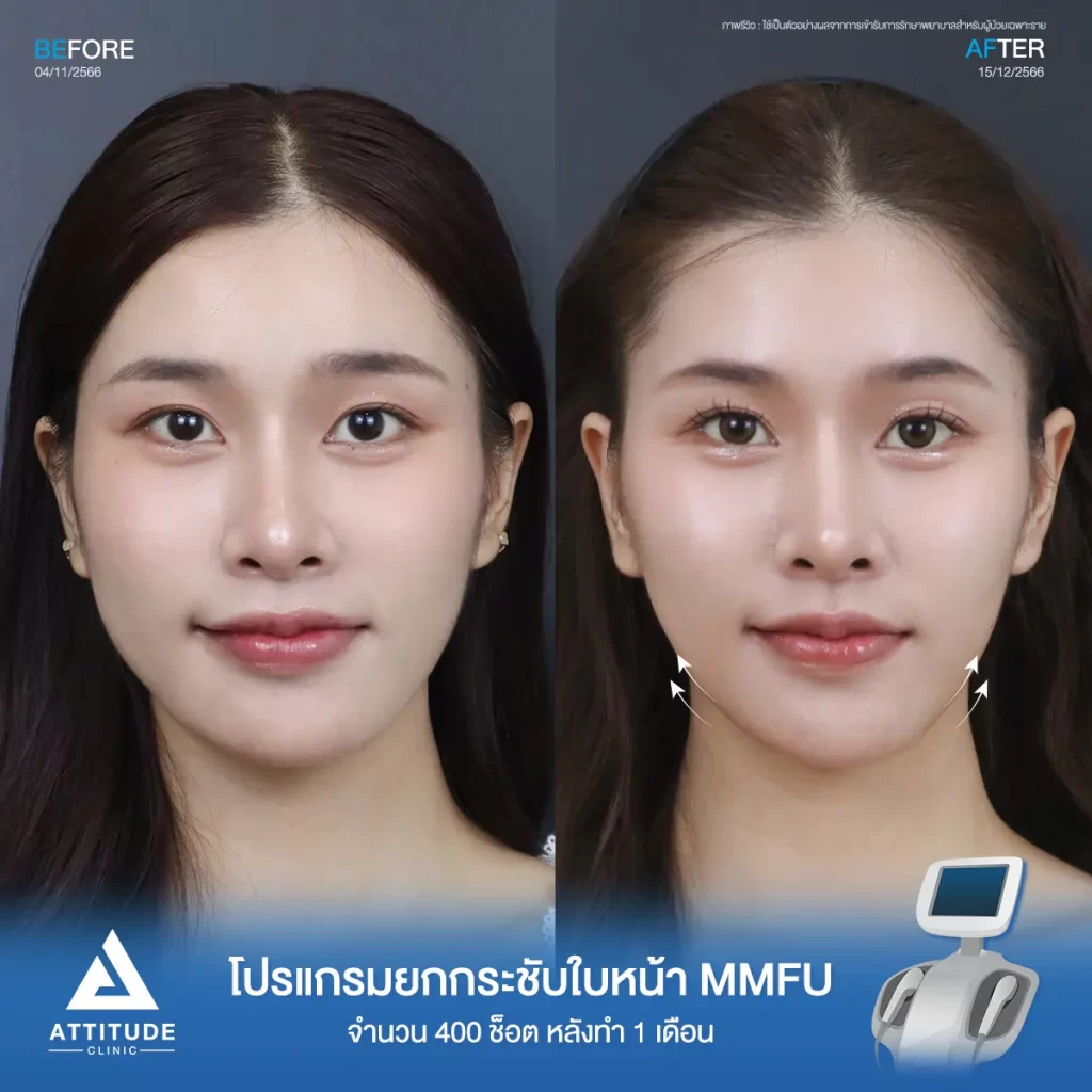 รีวิวโปรแกรมยกกระชับใบหน้า MMFU จำนวน 400 ช็อต หลังทำ 1 เดือนของน้องนาย ยกกระชับผิวบริเวณข้างแก้ม หน้าแก้ม เห็นกรอบหน้าชัดขึ้น หน้าเรียวสวยขึ้นที่ Attitude Clinic