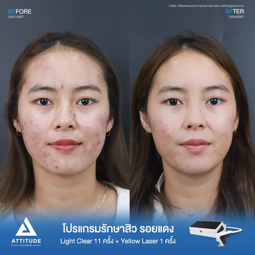 รีวิวรักษาสิวน้องซาร่า ด้วยการฉายแสง Light Clear 7 ขั้นตอน จำนวน 11 ครั้ง และเลเซอร์ Pro Yellow ลดรอยแดง จำนวน 1 ครั้ง รักษาสิวอักเสบ สิวฮอร์โมนที่ขึ้นบริเวณเดิมซ้ำๆ ช่วงมีประจำเดือน และรอยแดงสิวที่ Attitude Clinic