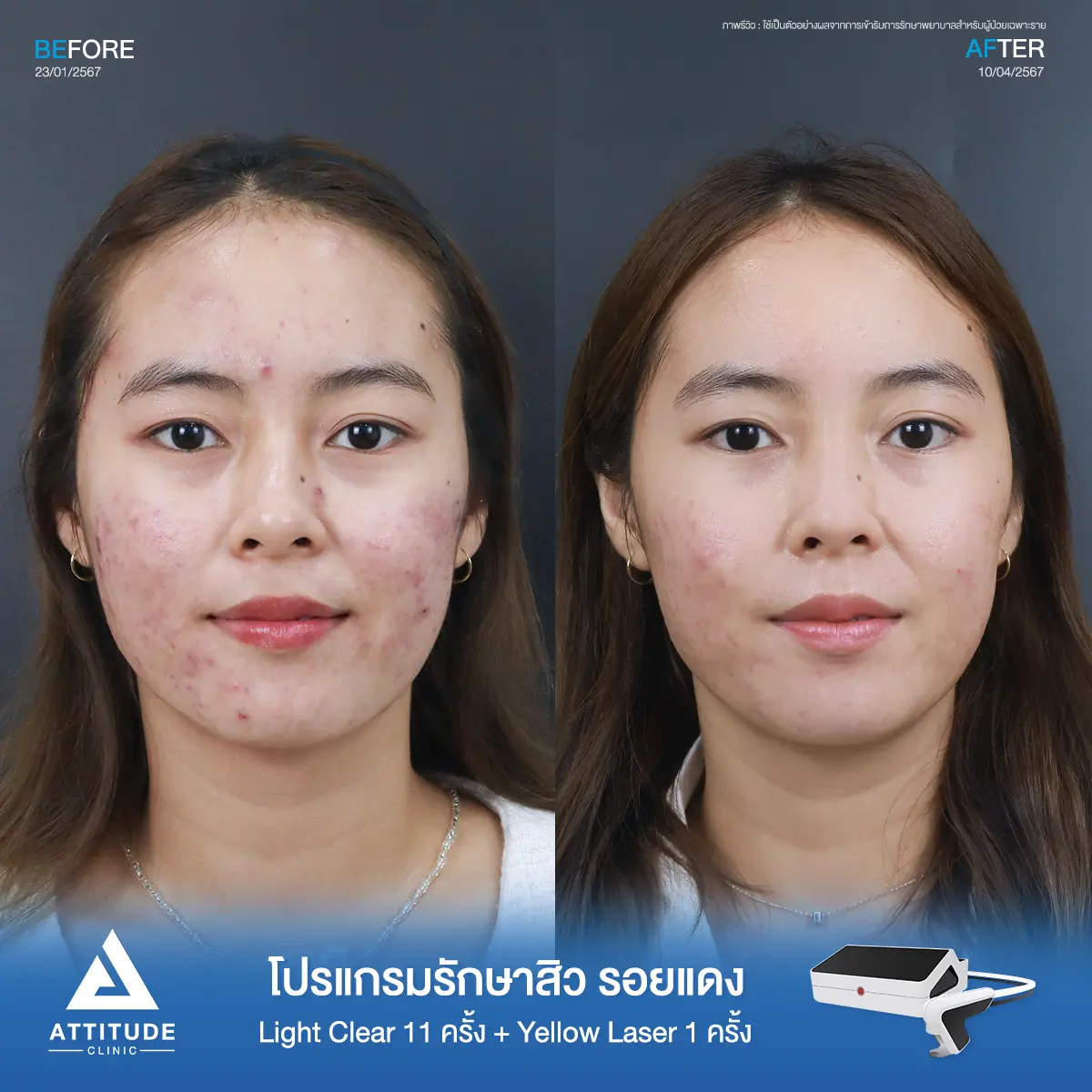 รีวิวรักษาสิวน้องซาร่า ด้วยการฉายแสง Light Clear 7 ขั้นตอน จำนวน 11 ครั้ง และเลเซอร์ Pro Yellow ลดรอยแดง จำนวน 1 ครั้ง รักษาสิวอักเสบ สิวฮอร์โมนที่ขึ้นบริเวณเดิมซ้ำๆ ช่วงมีประจำเดือน และรอยแดงสิวที่ Attitude Clinic