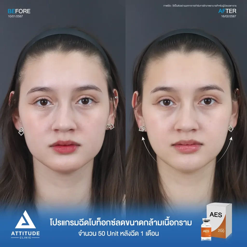 รีวิวโปรแกรมฉีดโบท็อกซ์ลดขนาดกล้ามเนื้อกรามคุณชาแนล จำนวน 50 Unit ปรับรูปหน้าให้ดูเรียวสวย เพิ่มมิติ ได้สัดส่วนมากขึ้นกับคุณหมอที่ Attitude Clinic