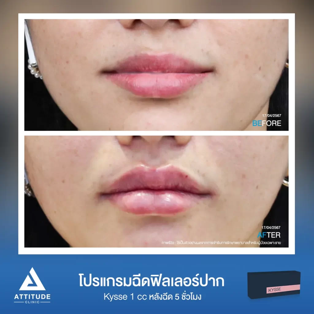 รีวิวโปรแกรมฉีดฟิลเลอร์ปากคุณแตบู่หล่ารุ่น KYSSE จำนวน 1 cc หลังฉีด 5 ชั่วโมง เติมเต็มริมฝีปากให้อวบอิ่ม ปากมีมิติได้ทรงสวย ดูสุขภาพดีที่ Attitude Clinic