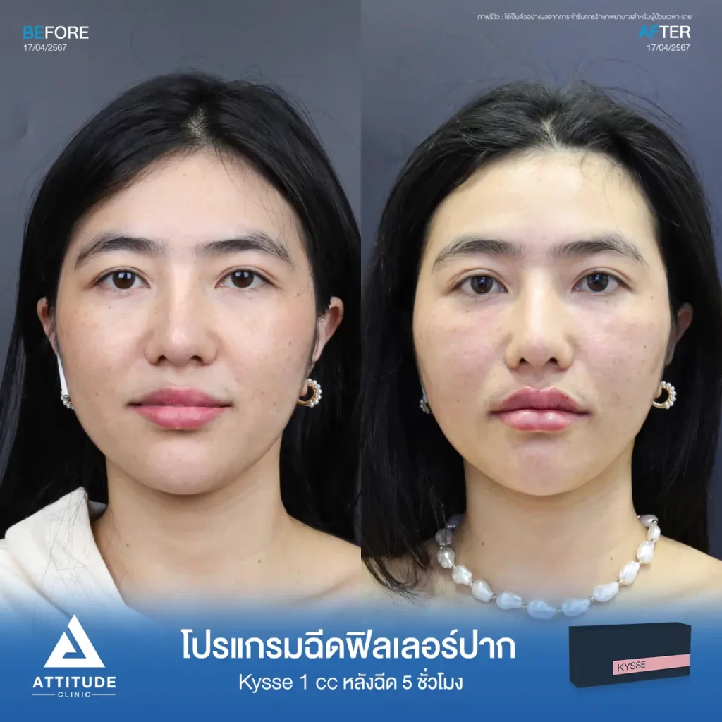 รีวิวโปรแกรมฉีดฟิลเลอร์ปากคุณแตบู่หล่ารุ่น KYSSE จำนวน 1 cc หลังฉีด 5 ชั่วโมง เติมเต็มริมฝีปากให้อวบอิ่ม ปากมีมิติได้ทรงสวย ดูสุขภาพดีที่ Attitude Clinic