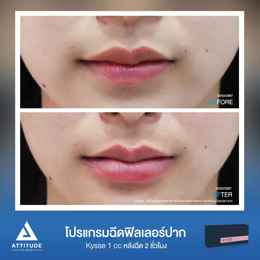 รีวิวโปรแกรมฉีดฟิลเลอร์ปากคุณนิ้ง รุ่น KYSSE จำนวน 1 cc หลังฉีด 2 ชั่วโมงของคุณนิ้ง เติมเต็มร่องริมฝีปาก ให้ปากอวบอิ่ม มีมิติได้ทรงสวย ปากชุ่มชื้น ดูสุขภาพดีที่ Attitude Clinic