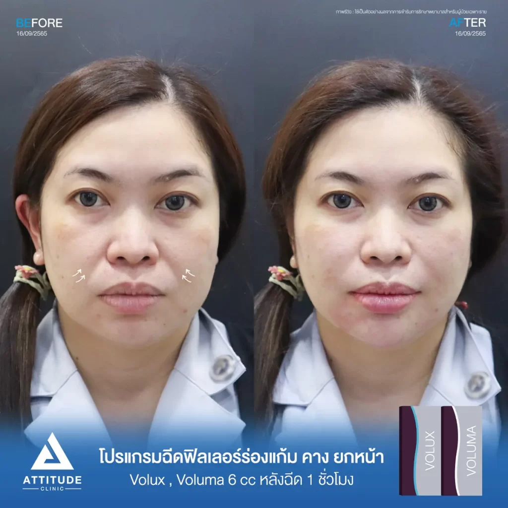 รีวิวโปรแกรมฉีดฟิลเลอร์ร่องแก้ม คาง ยกหน้าคุณนกยูงรุ่น Volux และ Voluma จำนวน 6 cc หลังฉีด 1 ชั่วโมง เติมร่องแก้มให้อิ่มฟู แก้หน้าโทรมให้ดูสดใส ปรับรูปหน้า ปรับคางเรียวสวย เพิ่มมิติให้ใบหน้าที่ Attitude Clinic