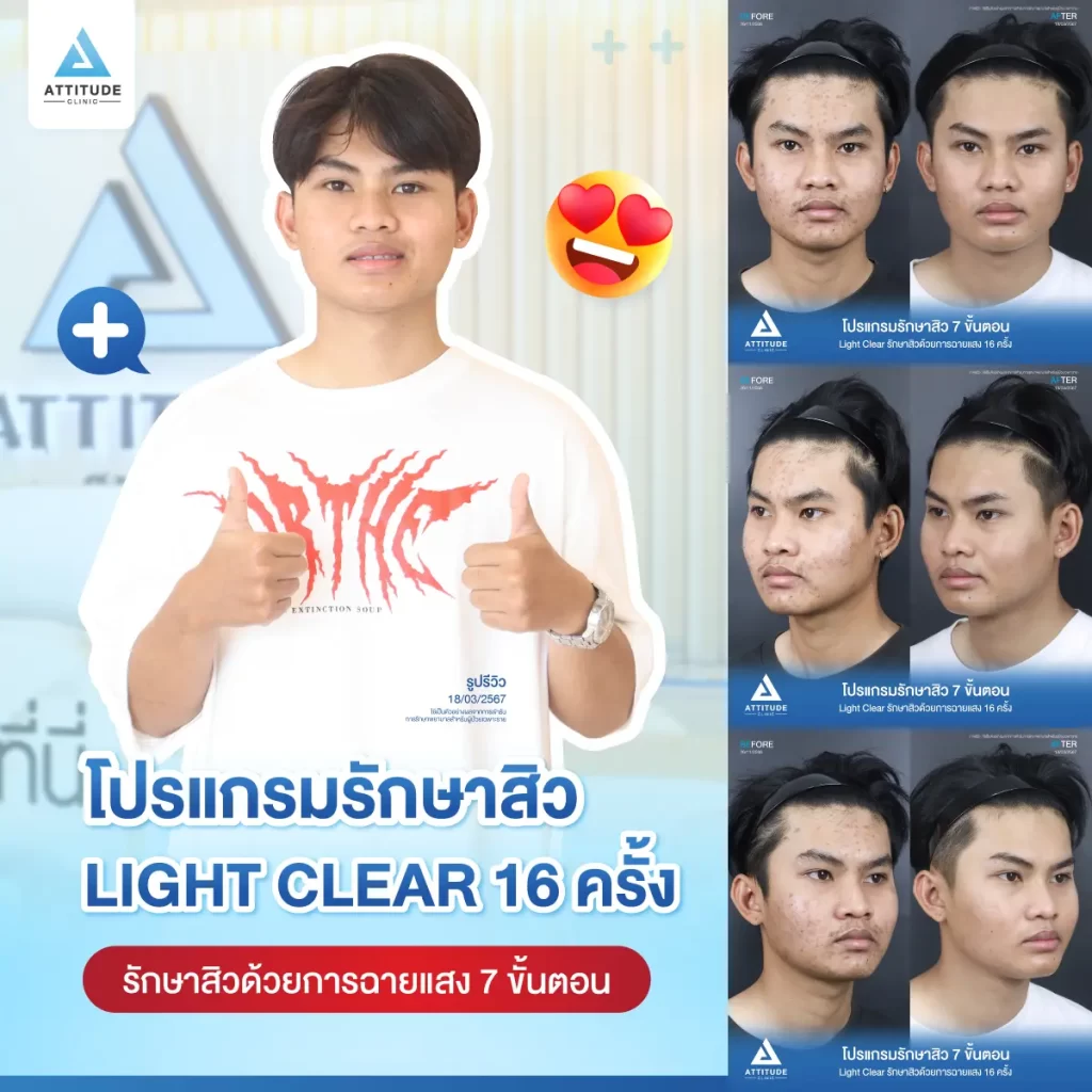 รีวิวรักษาสิวน้องบอส ด้วยการฉายแสง Light Clear 7 ขั้นตอน จำนวน 16 ครั้ง รักษาสิวอักเสบ สิวอุดตัน และรอยสิวทั่วใบหน้าที่ Attitude Clinic