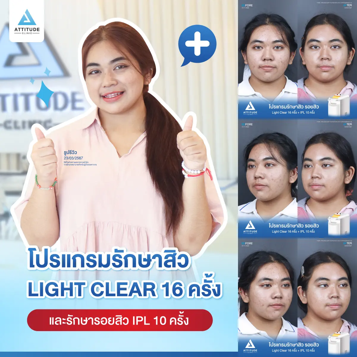 รีวิวรักษาสิวน้องปิงปิง ด้วยการฉายแสง Light Clear 7 ขั้นตอน จำนวน 16 ครั้ง และทำ IPL หน้าใส ลดรอยสิว จำนวน 10 ครั้ง รักษาสิวอุดตัน สิวผดเม็ดเล็กๆ และรอยสิวทั่วใบหน้าที่ Attitude Clinic