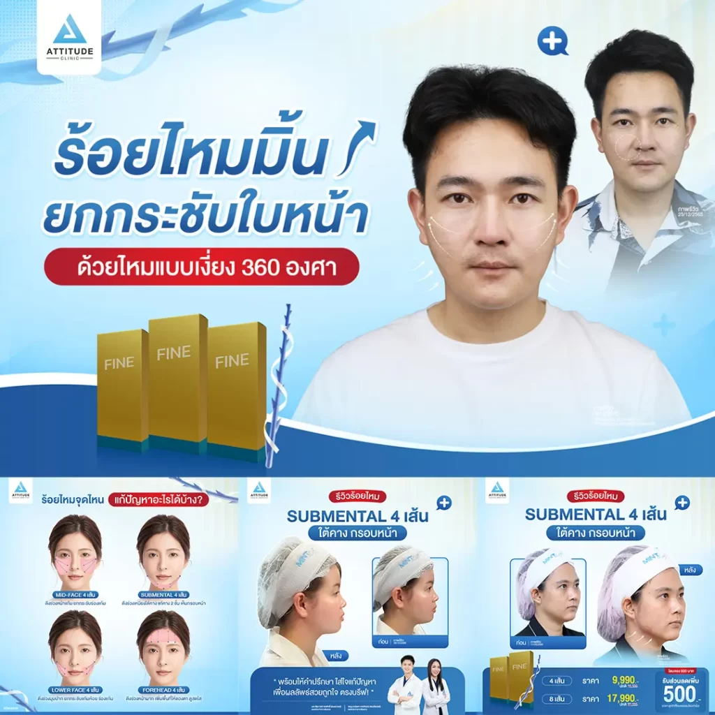 โปรแกรมร้อยไหมมิ้นท์ รุ่น Fine กับหมอต้อม ดึงยกกระชับใบหน้า ด้วยไหมแบบเงี่ยง 360 องศา ปรับรูปหน้า พลังยกรอบทิศทาง สิทธิพิเศษโอนจอง 500 บาท รับส่วนลดเพิ่ม 500 บาท รองรับการผ่อนชำระนาน 3 เดือน