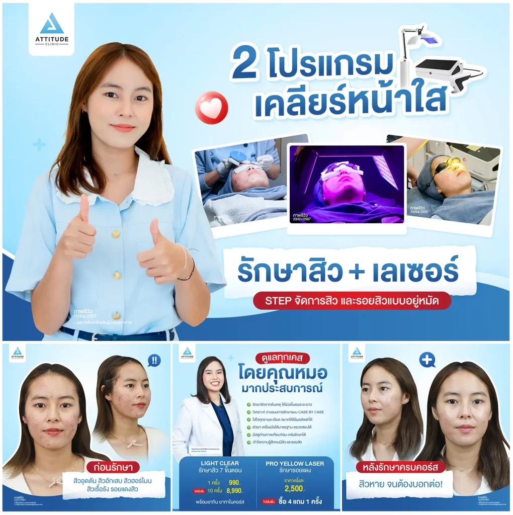 2 โปรแกรมเคลียร์หน้าใส รักษาสิว+เลเซอร์ Step จึ้งรักษาสิว และรอยสิวแบบอยู่หมัด