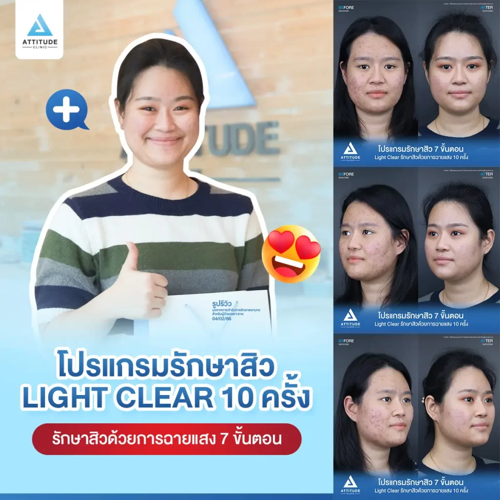 รีวิวรักษาสิวคุณธนาภา ด้วยการฉายแสง Light Clear 7 ขั้นตอน จำนวน 10 ครั้ง รักษาสิวอักเสบมีหนอง สิวอุดตัน รอยแดงสิวทั่วใบหน้าที่ Attitude Clinic