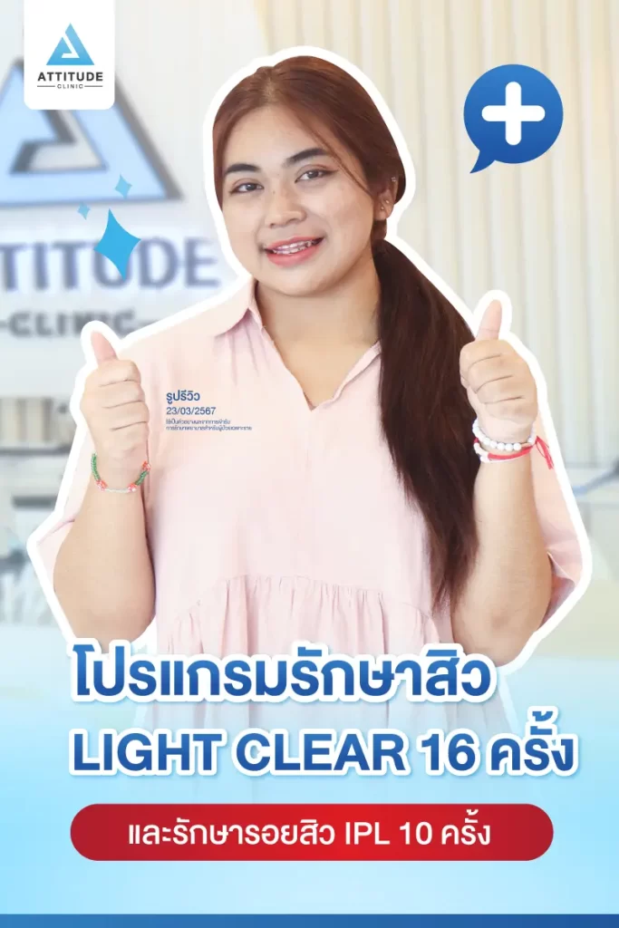 รีวิวรักษาสิวน้องปิงปิง ด้วยการฉายแสง Light Clear 7 ขั้นตอน จำนวน 16 ครั้ง และทำ IPL หน้าใส ลดรอยสิว จำนวน 10 ครั้ง รักษาสิวอุดตัน สิวผดเม็ดเล็กๆ และรอยสิวทั่วใบหน้าที่ Attitude Clinic
