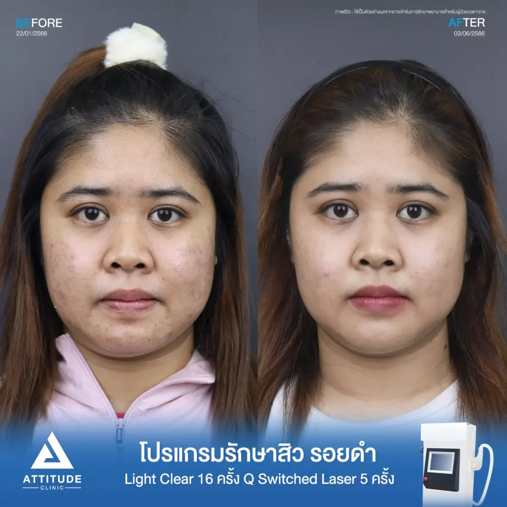 รีวิวรักษาสิวคุณจุฑาทิพย์ ด้วยการฉายแสง Light Clear 7 ขั้นตอน จำนวน 16 ครั้ง ทำ Q Switched Laser ลดรอยสิว จำนวน 5 ครั้ง รักษาสิวอุดตัน สิวผดเม็ดเล็กๆ รอยสิวดำจากสิวทั่วใบหน้าที่ Attitude Clinic