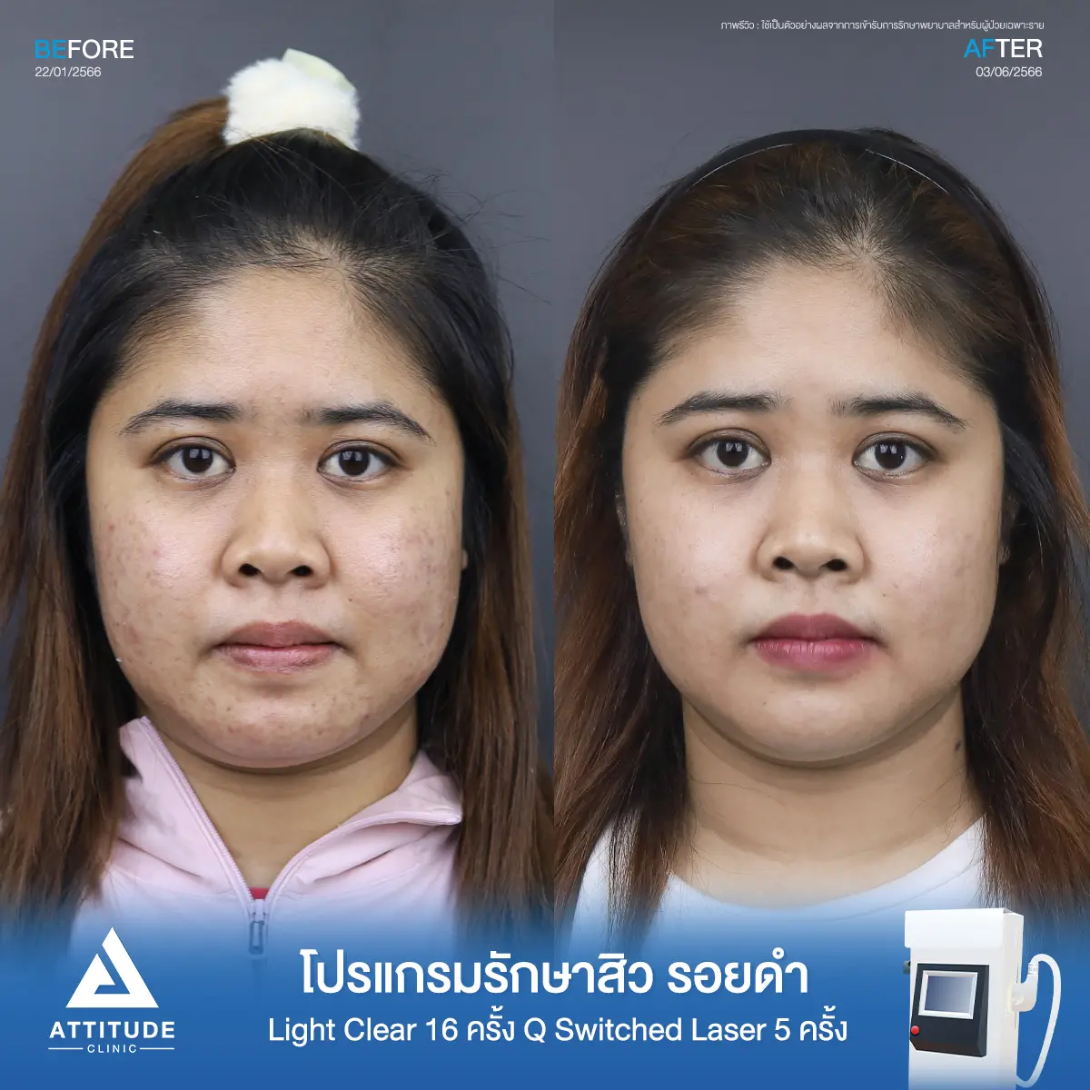 รีวิวรักษาสิวคุณจุฑาทิพย์ ด้วยการฉายแสง Light Clear 7 ขั้นตอน จำนวน 16 ครั้ง ทำ Q Switched Laser ลดรอยสิว จำนวน 5 ครั้ง รักษาสิวอุดตัน สิวผดเม็ดเล็กๆ รอยสิวดำจากสิวทั่วใบหน้าที่ Attitude Clinic