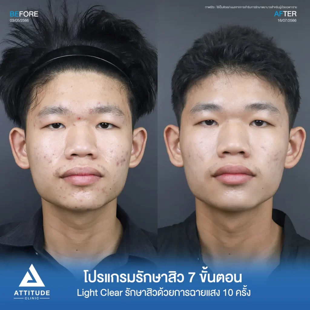 รีวิวรักษาสิวน้องณัฐปคัลภ์ ด้วยการฉายแสง Light Clear 7 ขั้นตอน จำนวน 10 ครั้ง รักษาสิวฮอร์โมน สิวอักเสบหัวหนอง สิวอุดตัน และรอยแดงทั่วใบหน้าที่ Attitude Clinic