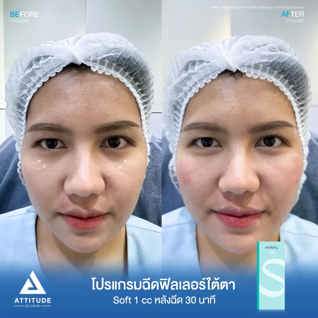 รีวิวโปรแกรมฉีดฟิลเลอร์ใต้ตาคุณเดียร์ รุ่น S จำนวน 1 cc หลังฉีด 30 นาที แก้ปัญหาใต้ตาหมองคล้ำ เติมเต็มร่องลึกใต้ตาให้อิ่มฟูกลับมาดูสดใส ไม่โทรม ลดริ้วรอยเล็กๆ ดูเป็นธรรมชาติที่ Attitude Clinic