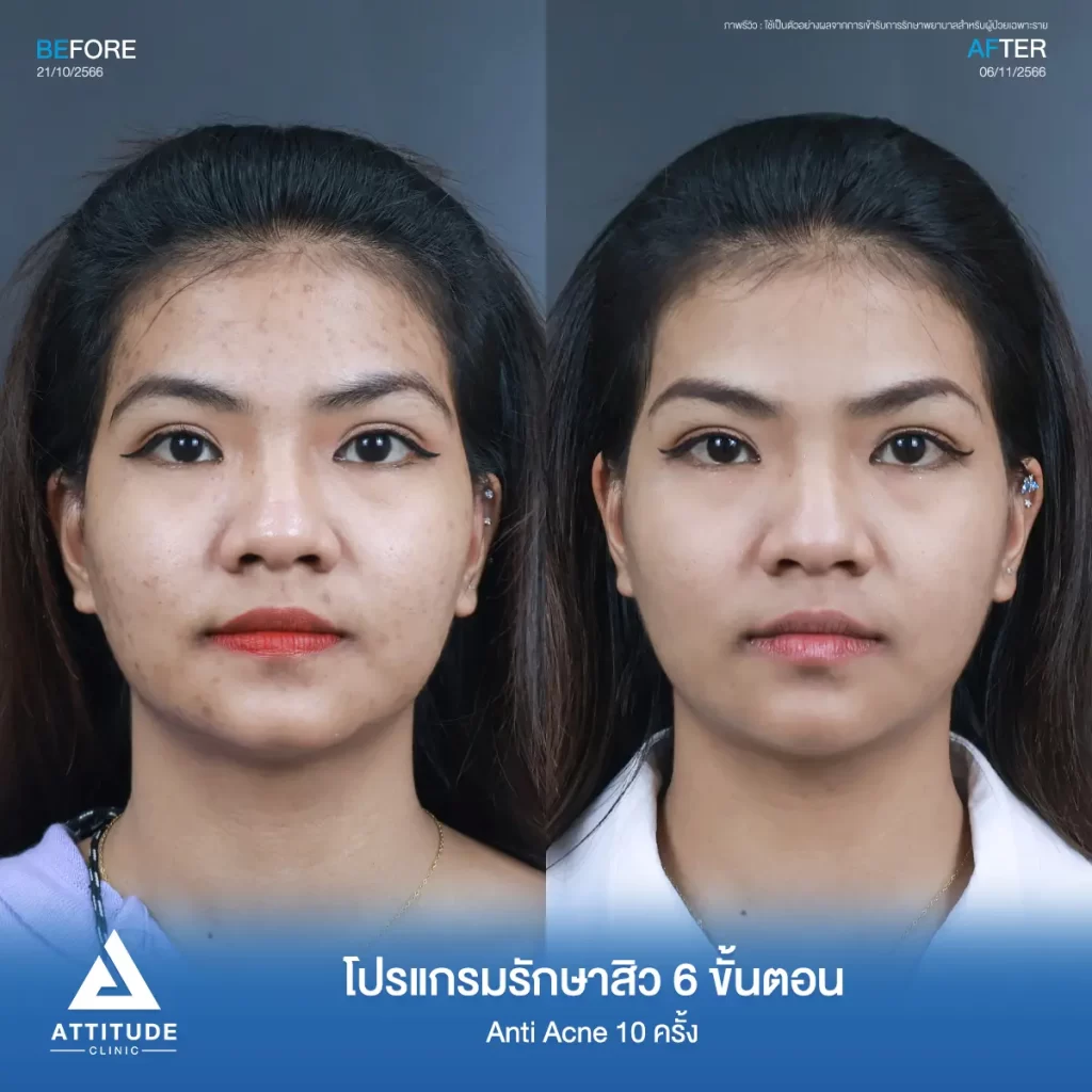 รีวิวรักษาสิวคุณกิ๊ฟ 6 ขั้นตอน โปรแกรม Anti Acne จำนวน 10 ครั้ง รักษาสิวอุดตัน สิวผดเม็ดเล็กๆ รอยสิวทั่วใบหน้า โดยเฉพาะบริเวณกรอบหน้าที่ Attitude Clinic