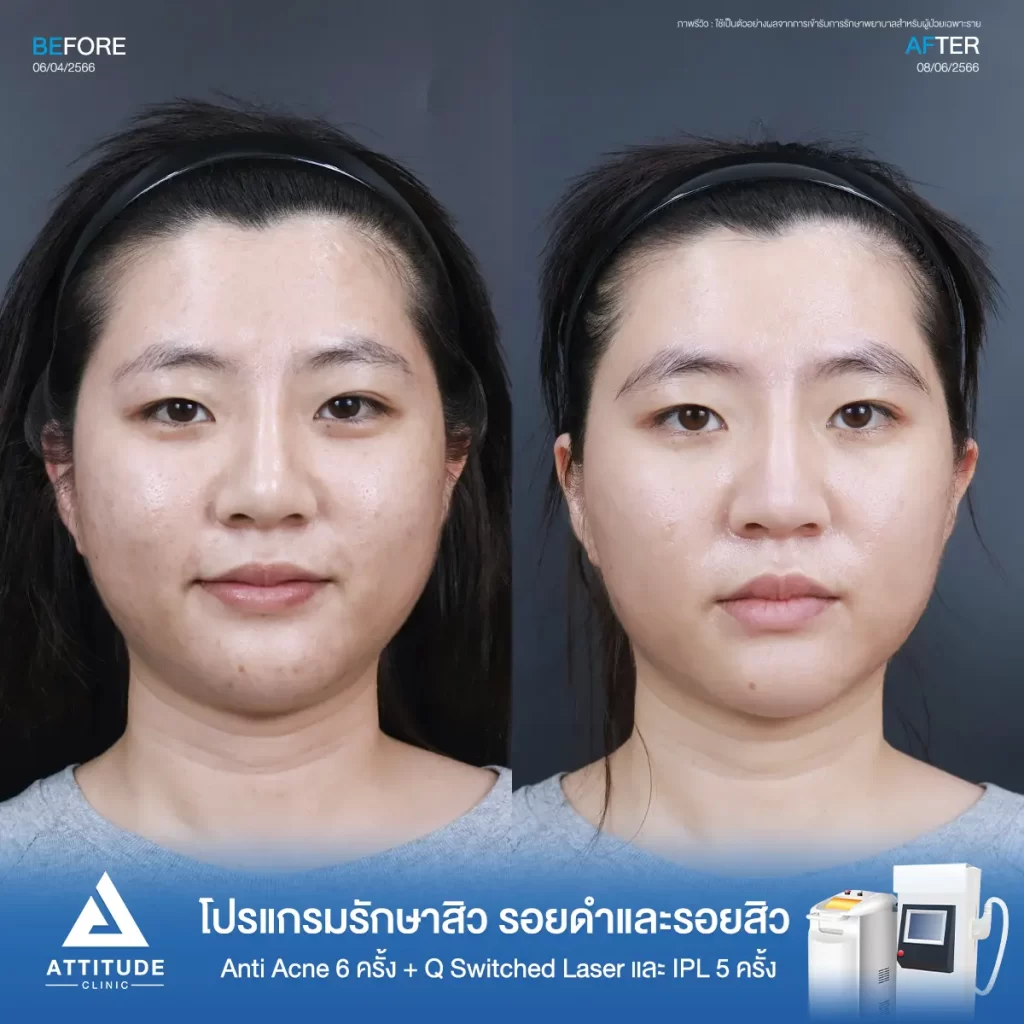 รีวิวรักษาสิวคุณขวัญ ด้วยการฉายแสง Light Clear 7 ขั้นตอน จำนวน 6 ครั้ง ทำ IPL หน้าใส และ Q Switched Laser ลดรอยสิว จำนวน 5 ครั้ง รักษาสิวอุดตัน สิวผดเม็ดเล็กๆ รอยสิว และผิวหมองคล้ำทั่วใบหน้า โดยเฉพาะบริเวณคางที่ Attitude Clinic