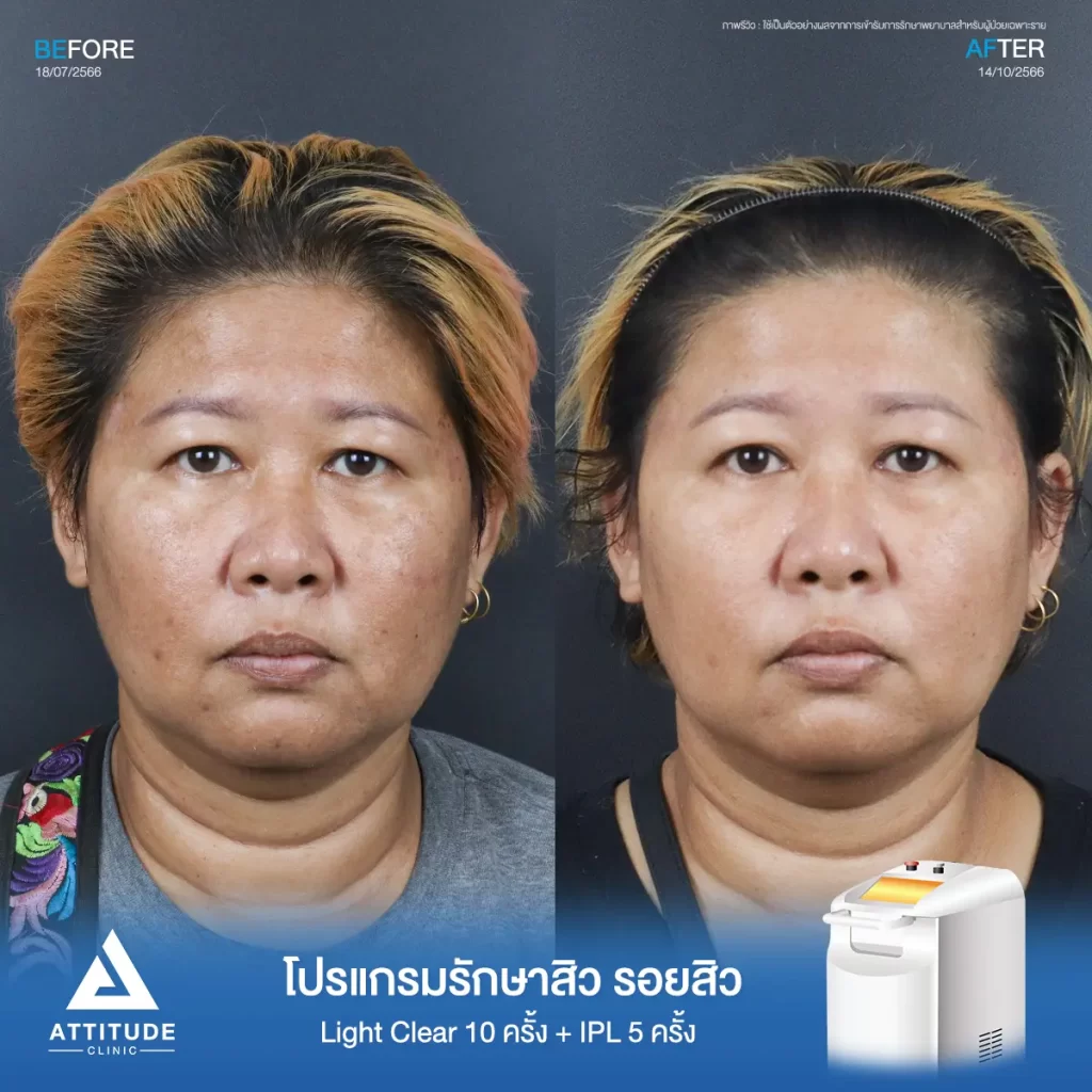 รีวิวรักษาสิวคุณปราง ด้วยการฉายแสง Light Clear 7 ขั้นตอน จำนวน 10 ครั้ง และทำ IPL หน้าใส ลดรอยสิว จำนวน 5 ครั้ง รักษาสิวอุดตัน สิวผดเม็ดเล็กๆ รอยสิว และลดความหมองคล้ำทั่วใบหน้าที่ Attitude Clinic