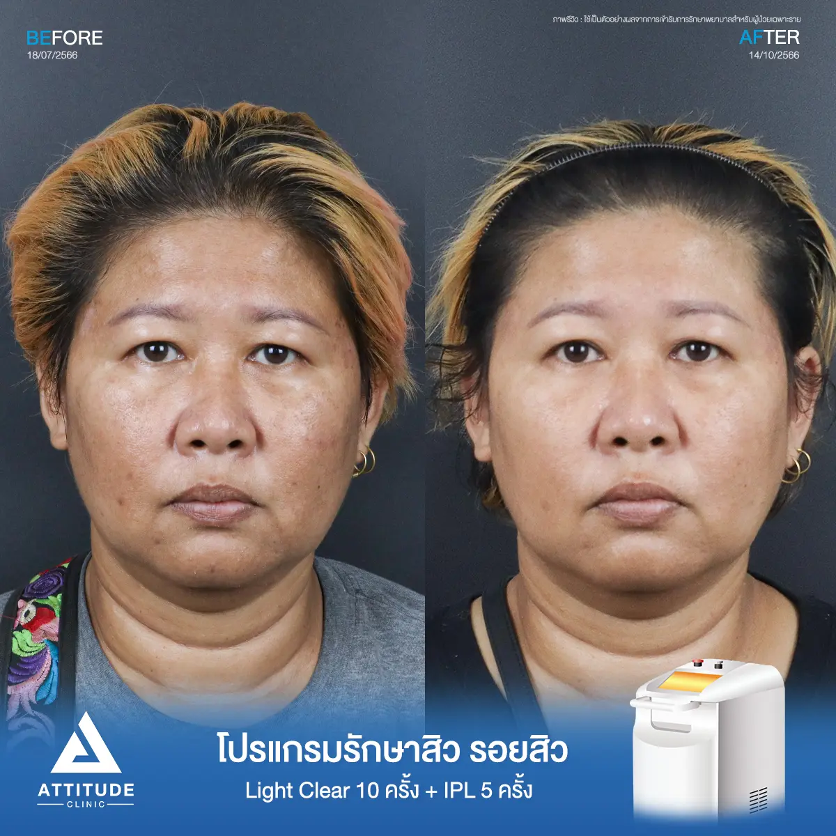 รีวิวรักษาสิวคุณปราง ด้วยการฉายแสง Light Clear 7 ขั้นตอน จำนวน 10 ครั้ง และทำ IPL หน้าใส ลดรอยสิว จำนวน 5 ครั้ง รักษาสิวอุดตัน สิวผดเม็ดเล็กๆ รอยสิว และลดความหมองคล้ำทั่วใบหน้าที่ Attitude Clinic