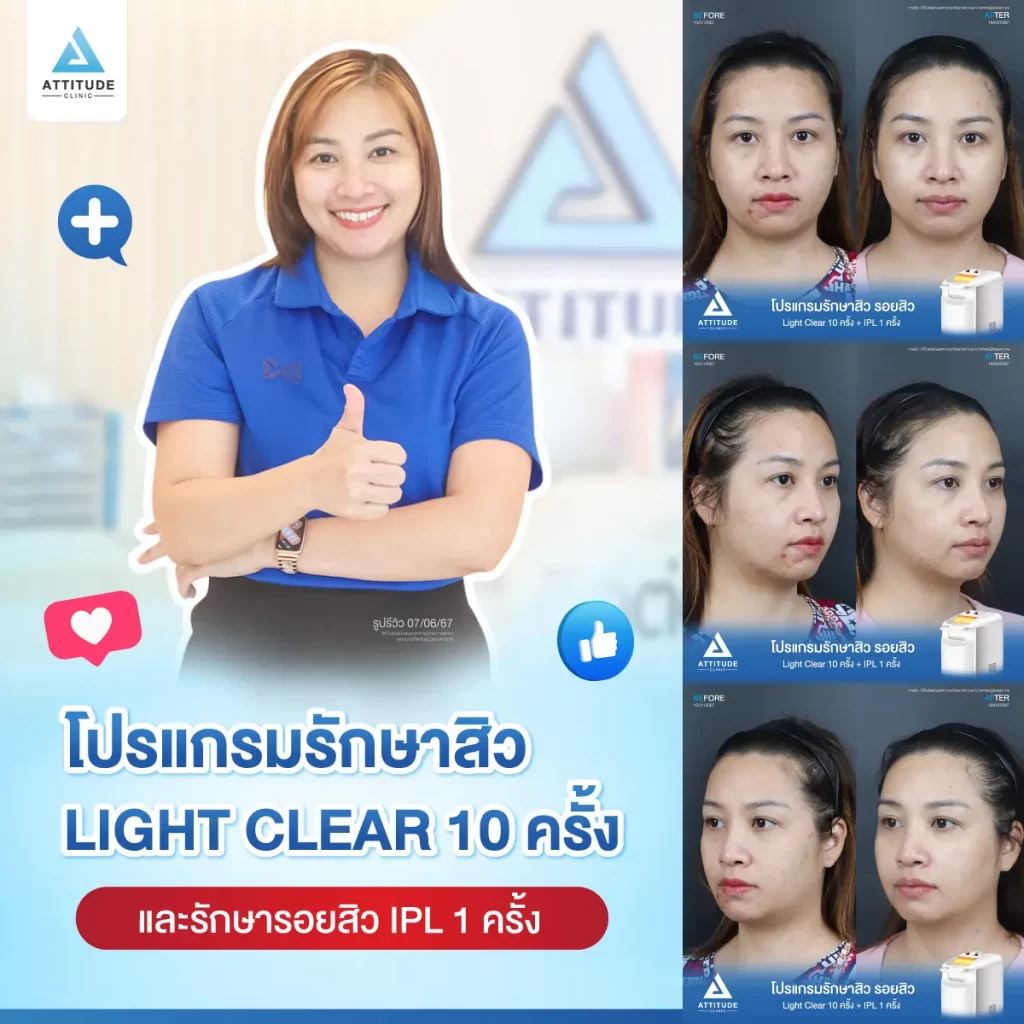 รีวิวรักษาสิวคุณอ้อ ด้วยการฉายแสง Light Clear 7 ขั้นตอน จำนวน 10 ครั้ง และทำ IPL หน้าใส ลดรอยสิว จำนวน 1 ครั้ง รักษาสิวอักเสบ สิวอุดตัน สิวผดเม็ดเล็กๆ รอยสิวทั่วใบหน้า โดยเฉพาะบริเวณคางที่ Attitude Clinic