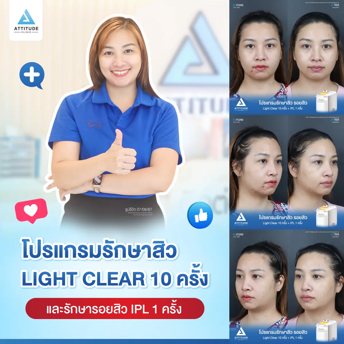 รีวิวรักษาสิวคุณอ้อ ด้วยการฉายแสง Light Clear 7 ขั้นตอน จำนวน 10 ครั้ง และทำ IPL หน้าใส ลดรอยสิว จำนวน 1 ครั้ง รักษาสิวอักเสบ สิวอุดตัน สิวผดเม็ดเล็กๆ รอยสิวทั่วใบหน้า โดยเฉพาะบริเวณคางที่ Attitude Clinic